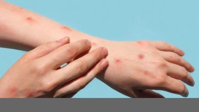 Monkey Pox Alert - ਮੰਕੀਪਾਕਸ ਦਾ