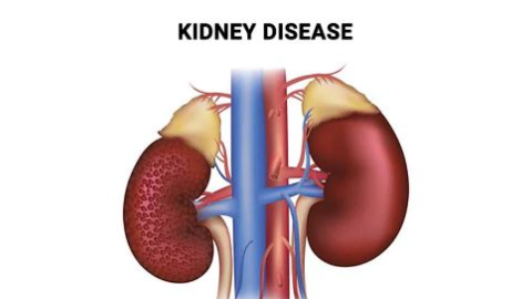 Kidney Disease- ਕਈ ਖ਼ਤਰਨਾਕ ਬਿਮ