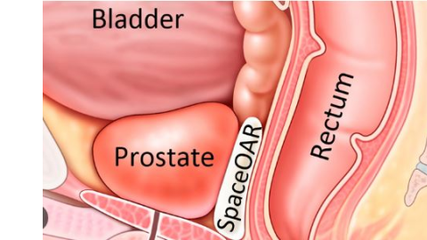 Prostate Cancer - ਭਾਰਤ 'ਚ ਪੁਰਸ਼